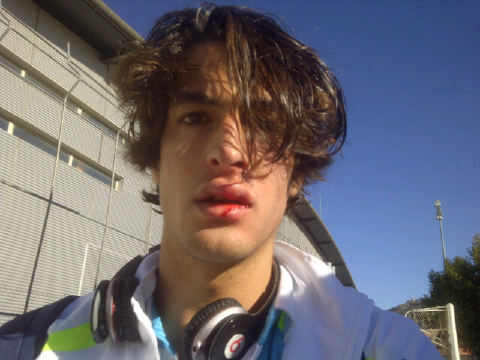 Dani Provencioha colgado una foto en la que aparece con el labio partido